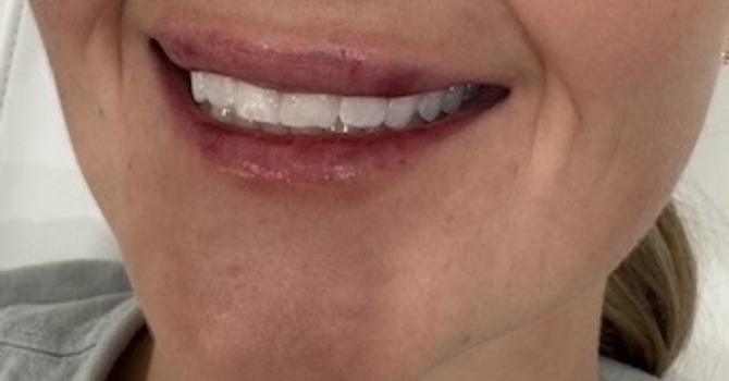 Your First Aesthetic Injection Appointment: What to Expect (and Why You’ll Be Fine!) image